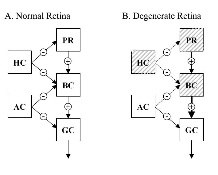 정상망막 (A)과 변성망막(B)의 망막신경회로망. PR: 시세포 (Photo receptor), HC: 수평세포 (Horizontal cell), BC: 양극세포 (Bipolar cell), AC: 아마크린세포 (Amacrine cell), GC: 신경절세포 (Ganglion cell)