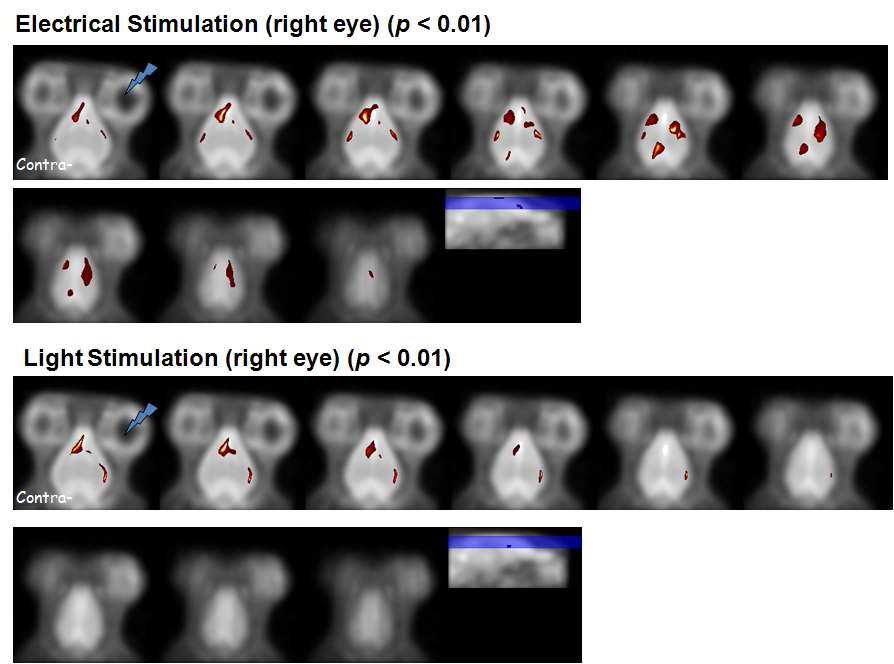 망막 변성모델에서 전기자극(상) 또는 빛자극(하) 에 의해 활성화 되는 피질 영역.