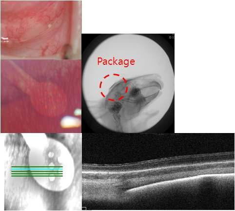 완전이식형 액정폴리머 패키지 삽입 후 7개월 경 결막하 패키지 연결부(위), 안저사진(가운데왼쪽), X-ray 사진(가운데 오른쪽), 빛간섭단층촬영(아래)