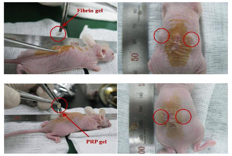 Fibrin gel과 PRP gel을 피하에 이식