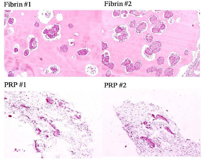 피하에 이식된 Fibrin gel과 PRP gel에서 췌도세포의 형태