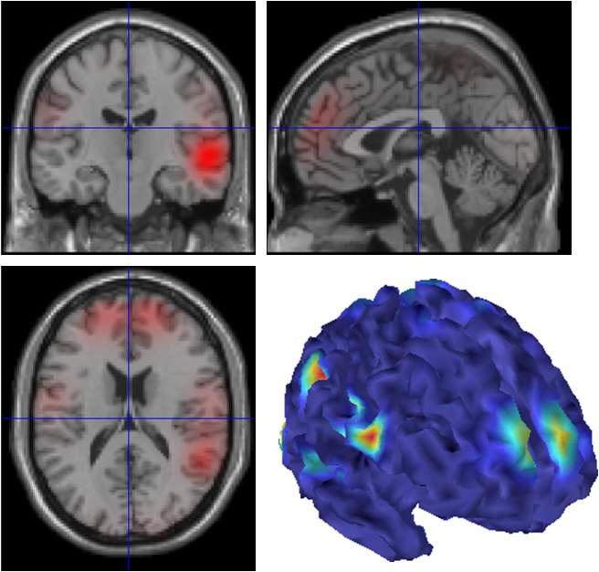 MRI에서 추출한 cortical surface 상에 발작 중 뇌파 신호 매핑