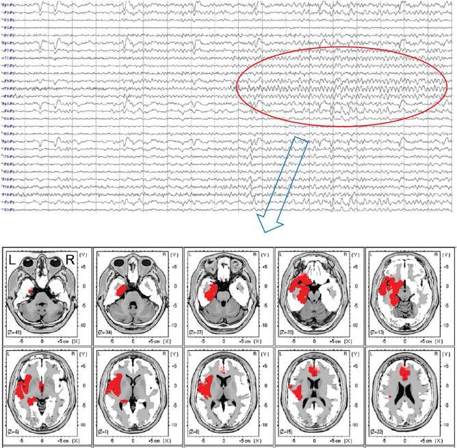 두피뇌파에서 측두엽간질환자의 발작중 두피뇌파 및신호원 국지화 매핑(Type 1 측두엽간질)