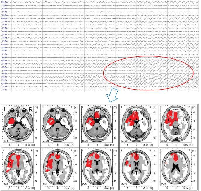두피뇌파에서 측두엽간질환자의 발작중 두피뇌파 및신호원 국지화 매핑(Type 2 측두엽간질)