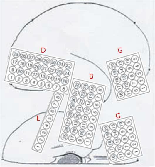 intracranial EEG electrode의 위치