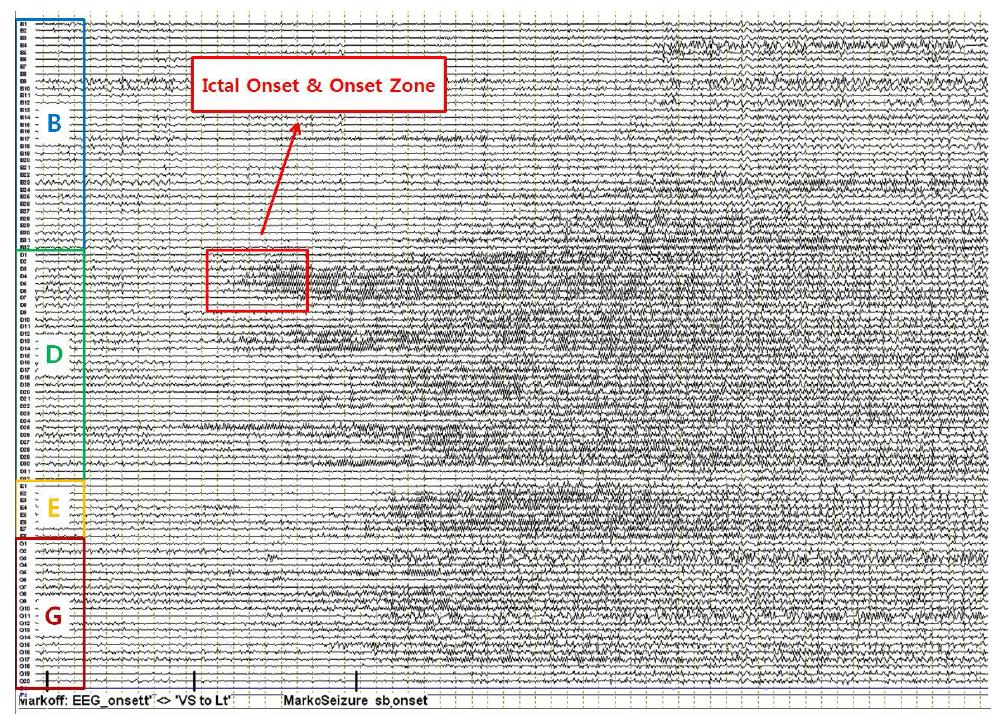 발작중 뇌파의 발작 개시 전후 60초 구간의 뇌파