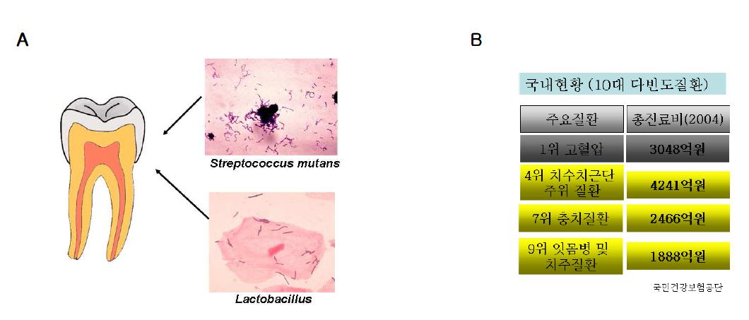 구강내 세균에 의해 발생하는 치아 우식증과 국내 10대 다빈도질환의 양상.