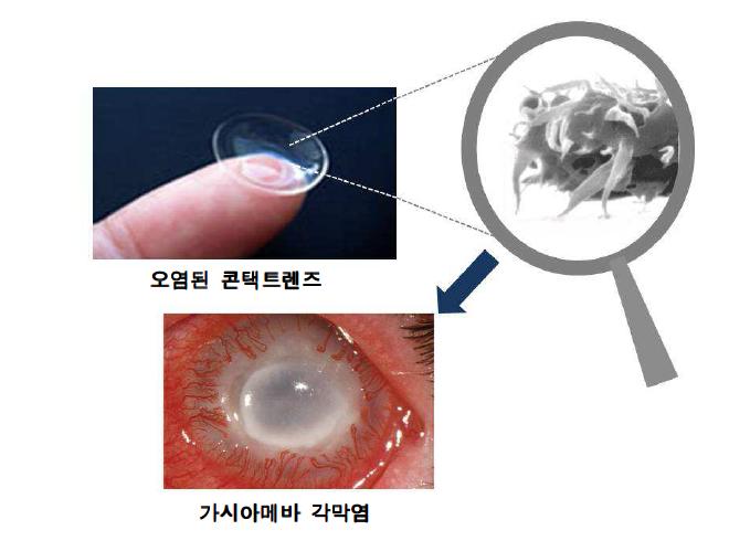 오염된 콘택트렌즈 착용으로 인한 가시아베바 각막염