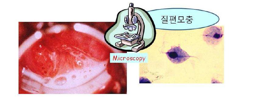 질편모충증과 질편모충