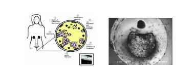 요도 카테터 박테리아의 바이오 필름 형성 과정 (좌) 환자에서 제거한 감염된 실리콘 카테터의단면 모습(우)