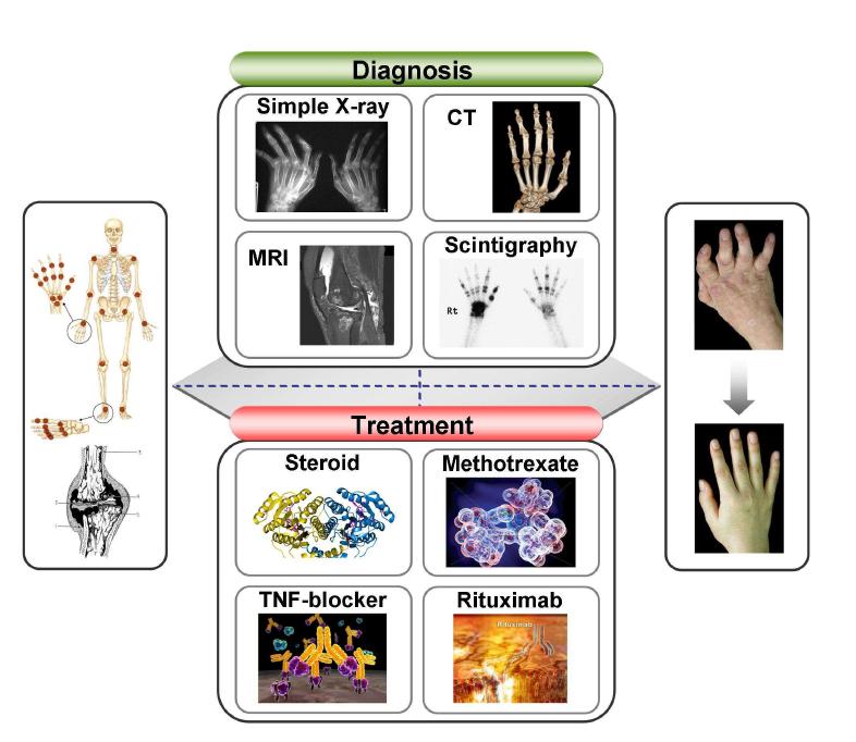 류마티스 관절염의 진단과 치료의 current modalities