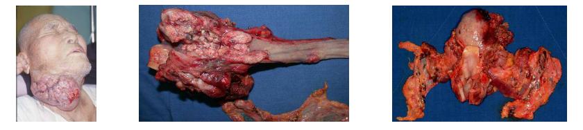 두경암의 하나인 하인두암의 경부전이 사진 (좌), 하인두암의 수술시료로 후두, 인두, 식도, 갑상선을 모두 포함해서 절 제술을 시행한 사진 (중), 설암의 후두 침범으로 전설절제술 및 후두와 인두를 절제하고 경부전이로 인해 경부절제술을 시행한 사진