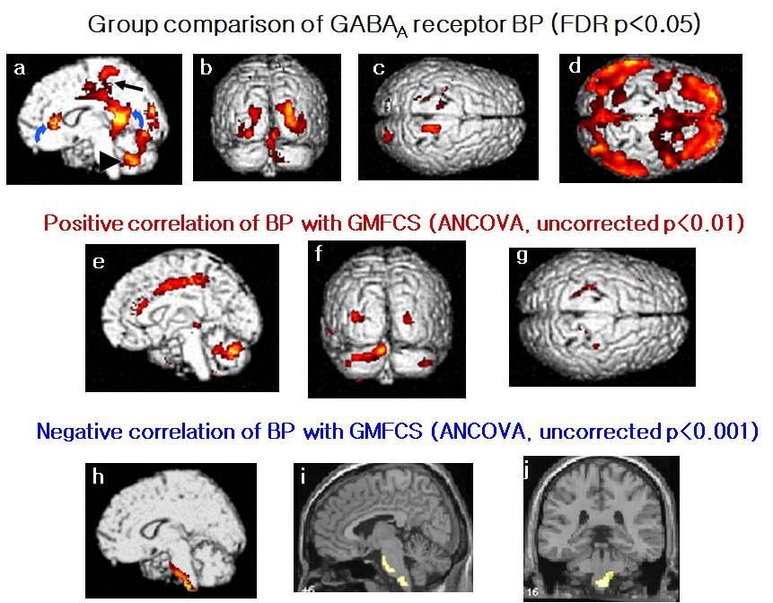 영역별 GABAA 수용체 Binding Potential에 대한 통계적 분석과 SDCP환자의 운동기능 장애와의 상관성 분석