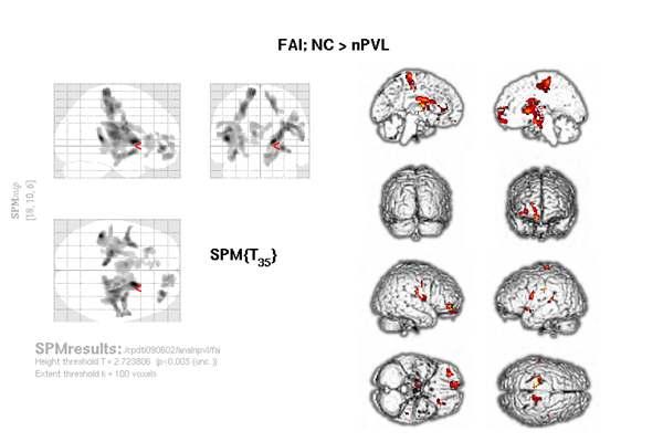 T=2.72, uncorrected p < 0.005, cluster:100