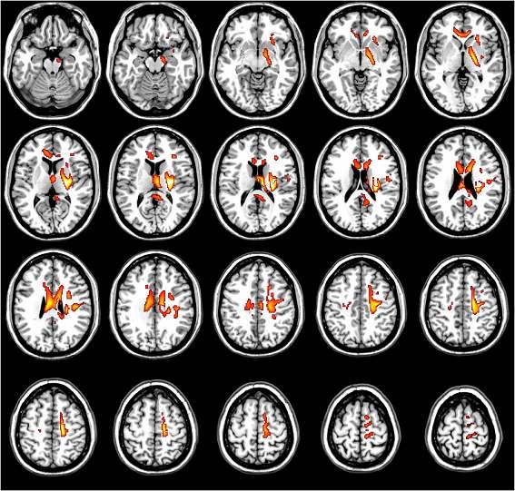 FAI density in patients with SD CP Hemiplegic compared with NC(NC>Hemi CP).