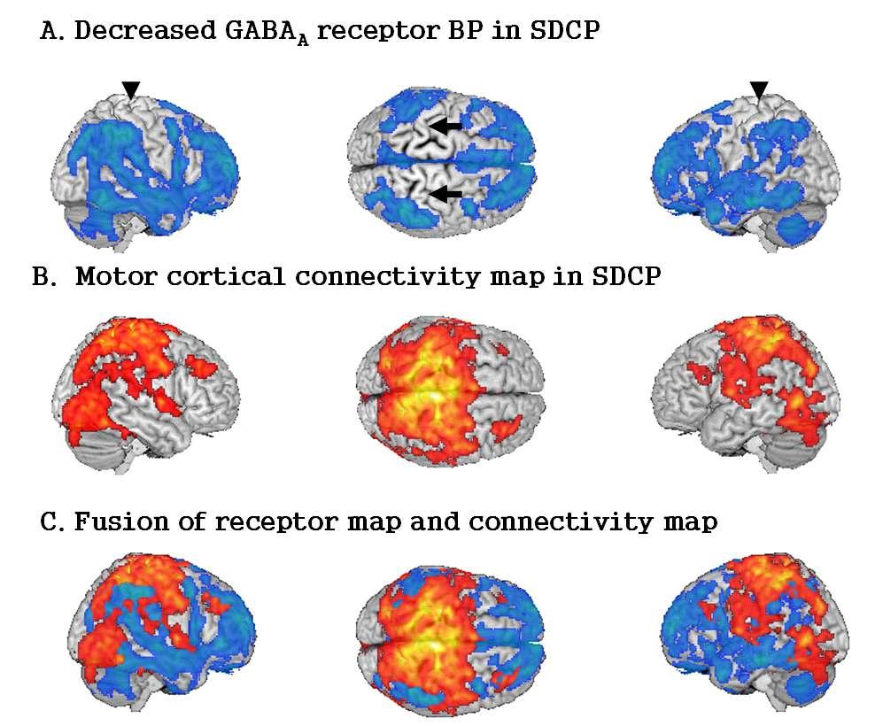 SDCP환자의 GABAA 수용체의 Binding Potential과 주 운동 피질을 기반으로 한 신경 연결성에 대한 비교