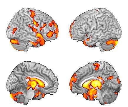 GM density in patients with SD CP Hemiplegic compared with NC,