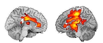 FAI density in patients with SD CP Hemiplegic compared with NC(NC>Hemi CP).