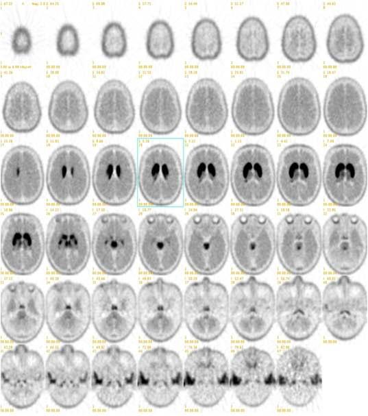 Representative images of F-18 FP-CIT PET for doapmine transporter imaging with CP