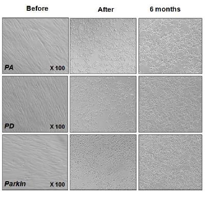 파킨슨환자 및 뇌하수체 선종환자의 지방유래 간엽줄기세포의 hTERT plasmid를 이용한 세포불멸화