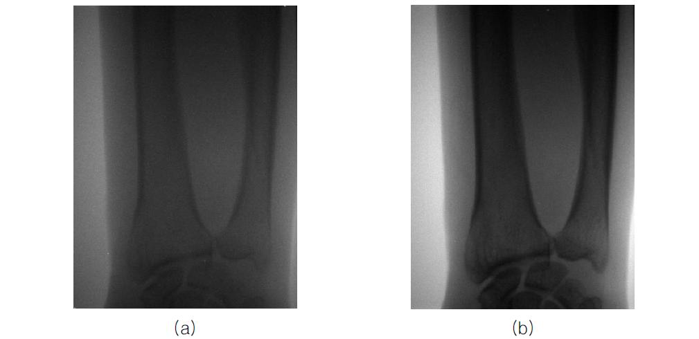 실험에 사용된 DEXA 영상((a) High에너지에 의한 영상, (b) Low 에너지에 의한 영상)