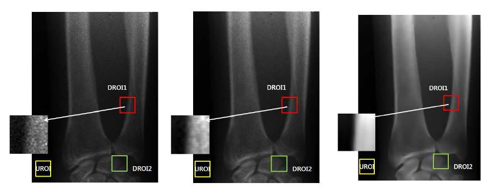 제안된 방법을 통한 X-ray 영상 잡음 제거를 통한 뼈 분리 결과 영상