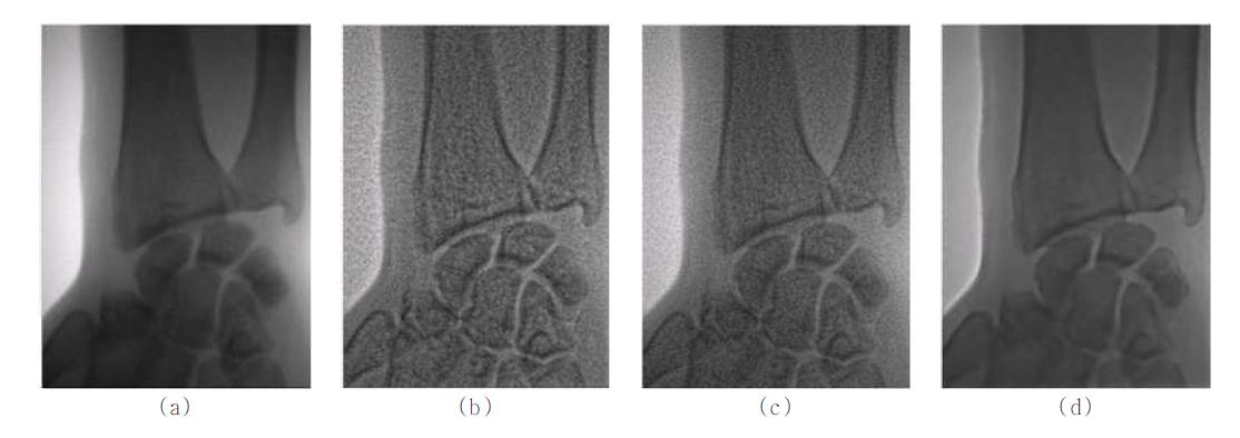 손목뼈에 대한 영상 향상 결과 ((a)원본 영상, (b)Non-linear mapping 결과 영상, (c)Scatter reduction 결과 영상, (d) 제안된 방법을 통한 최종 결과)