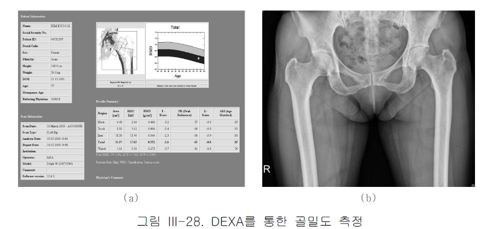 DEXA를 통한 골밀도 측정((a) 골밀도 측정 결과(예시), (b) 대퇴부 방사선 영상 예시)