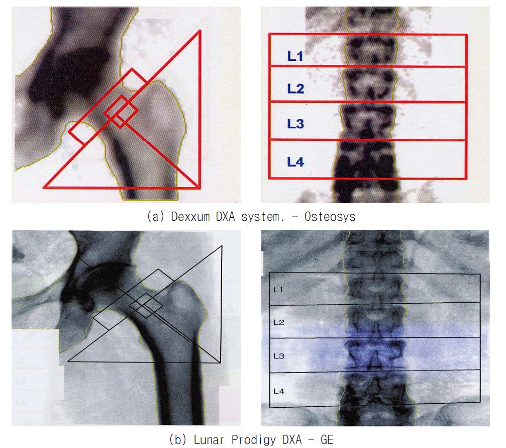 Lumar와 Spin의 골밀도 측정을 위한 Image