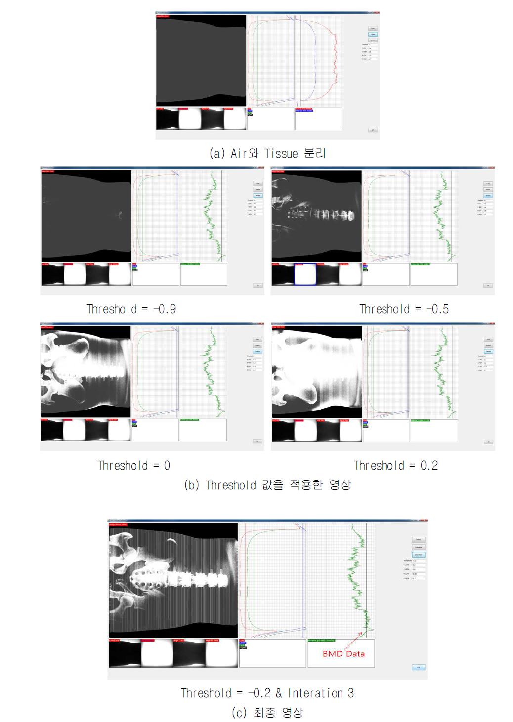 Cone Beam 이미지를 이용한 BMD 측정 및 영상 개선