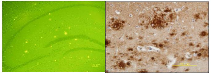 Various size of amyloid beta deposits in the brain tissue of B6C3 transgenic mice after thioflavin S (left panel) and amyloid beta immunohistochemistry (right panel) staining. Magnifications and scale bars, 100x and 100 μm (left panel), and 400x and 100 μm (right panel).