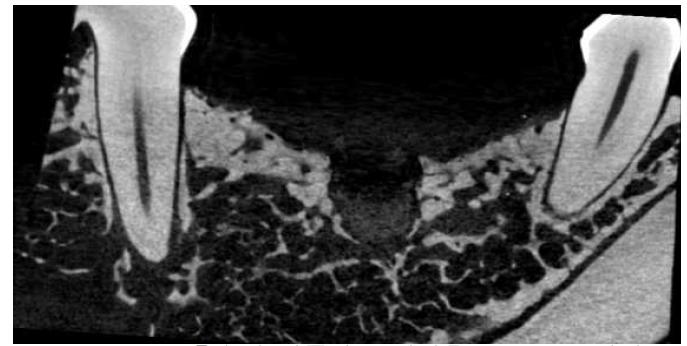 흡수성 임플란트 이식후 micro-CT 사진