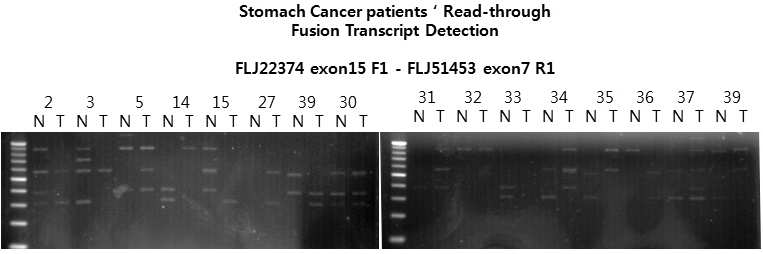 그림 2-6. 위암 환자의 normal과 tumor 조직에서 fusion transcript를 비교한 RT-PCR결과