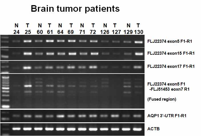 그림 2-17. Brain tissue의 normal-tumor pair에서 FLJ22374과 FLJ22374-AQP1 read-through transcript 및 AQP1의 발현을 RT-PCR로 detect한 결과