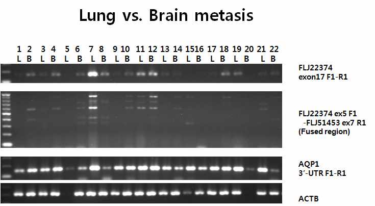 그림 2-18. Lung cancer와 brain metastasized tumor조직에서의 FLJ22374, AQP1 그리고 fusion transcript의 발현정도비교.