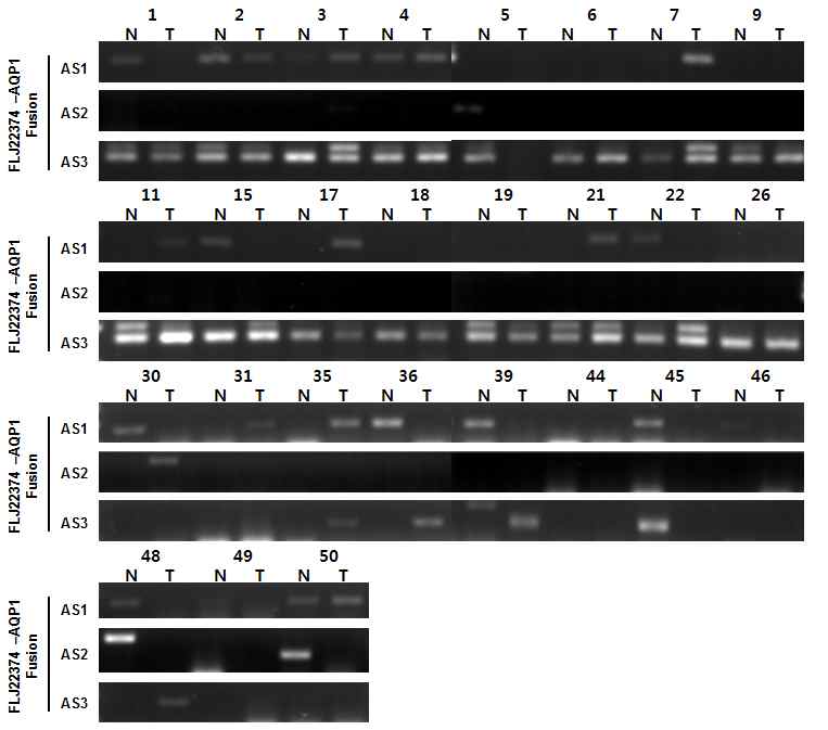 그림 2-55. FLJ22374-AQP1 fusion transcript의 AS form을 27 pair의 위암환자 시료를 통하여 비교한 결과