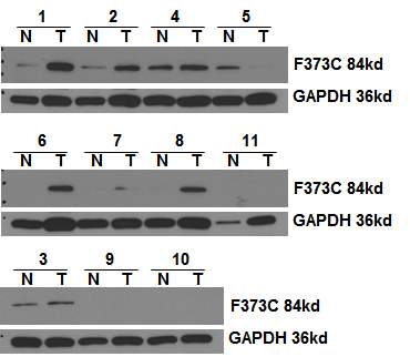 그림 2-79. 진행성 위암환자의 tissue lysate를 이용하여 FLJ22374 특이적 antibody로 detection한 결과