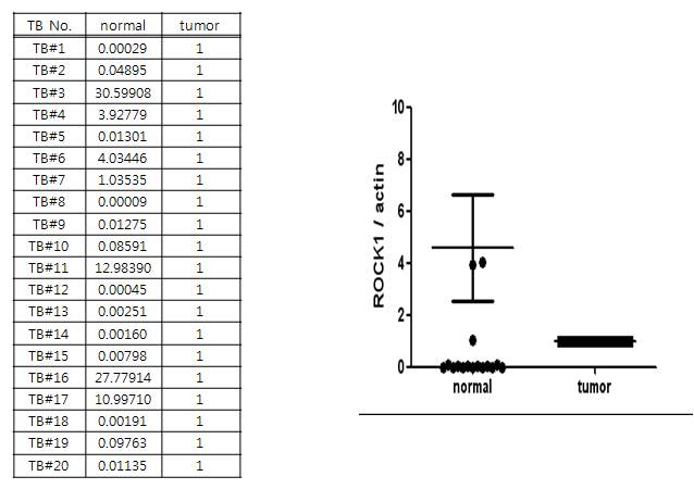 Figure20. 정상환자와 위암환자의 조직에서 ROCK1 발현을 real-time PCR로 확인