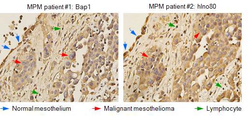 그림 12. MPM 환자조직에서 Bap1 및 Ino80 발현 감소