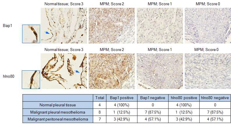 그림 13. 흉막/복막 중피종 tissue microarray를 대상으로 Bap1 및 Ino80 발현 분석