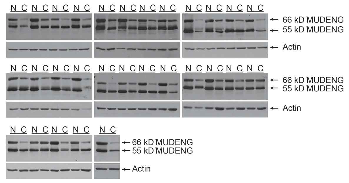 그림 23. 환자로부터 얻은 암조직(C)과 암조직 옆에 있는 정상조직(N)을 homogenizer로 분쇄한 후 단백질을 추출하였다. 단백질 추출물을 SDS-PAGE에 전기영동하였고 MUDENG 항체로 western blot 하였다