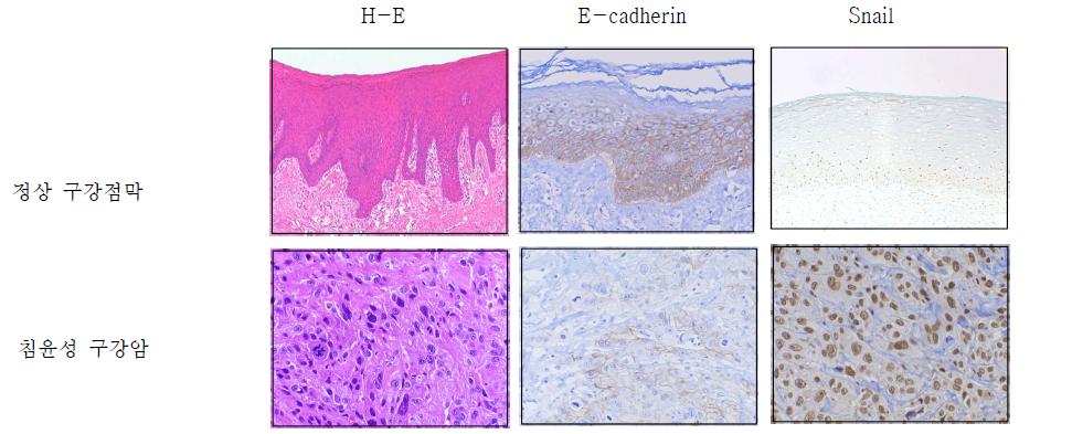 정상 구강점막에서는 기저층 상부와 가시층에 E-cadherin 발현이 강하고, Snail은 기저층의 일부 세포에서 관찰됨에 반하여 (윗줄), 침윤성 편평세포암종에서는 E-cadherin 발현이 거의 없고, Snail은 핵에서 강하게 발현됨. Snail과 E-cadherin의 발현은 역상관 관계임을 알 수 있음.