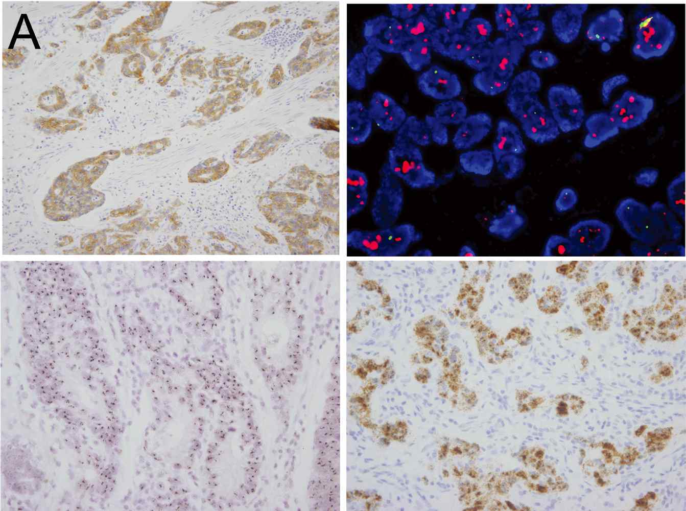 그림 5. 왼쪽위, 면역화학염색 (IHC); 오른쪽 위, 형광교잡법 (FISH); 왼쪽 아래, 은교자법 (SISH); 오른쪽 아래, mRNA 교잡법, 모두 HER2 증폭과 과발현을 보인 증례임