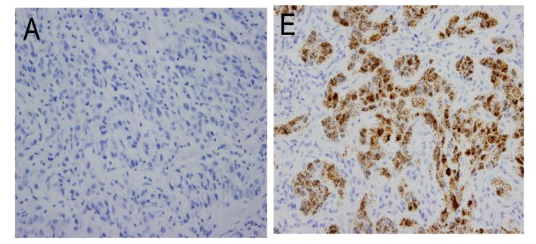 그림 6. HER2 유전자의 mRNA in situ hybridization 소견