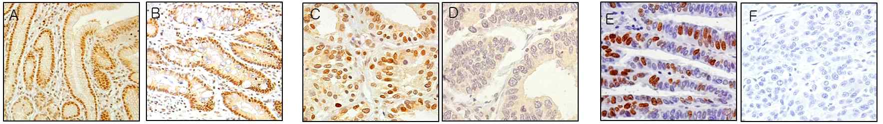 그림 18. Nuclear pSTAT3 was expressed in the proliferative zone in normal gastric mucosa (A) and in areas of intestinal metaplasia (X 200) (B). Gastric carcinoma cells showing nuclear pSTAT3 expression (X 400) (C). Gastric carcinoma cells without nuclear pSTAT3 expression (X 400) (D). Gastric carcinoma cells showing Ki-67 expression in the nucleus (X 400) (E). A negative control treated without primary antibodies (X 400) (F).
