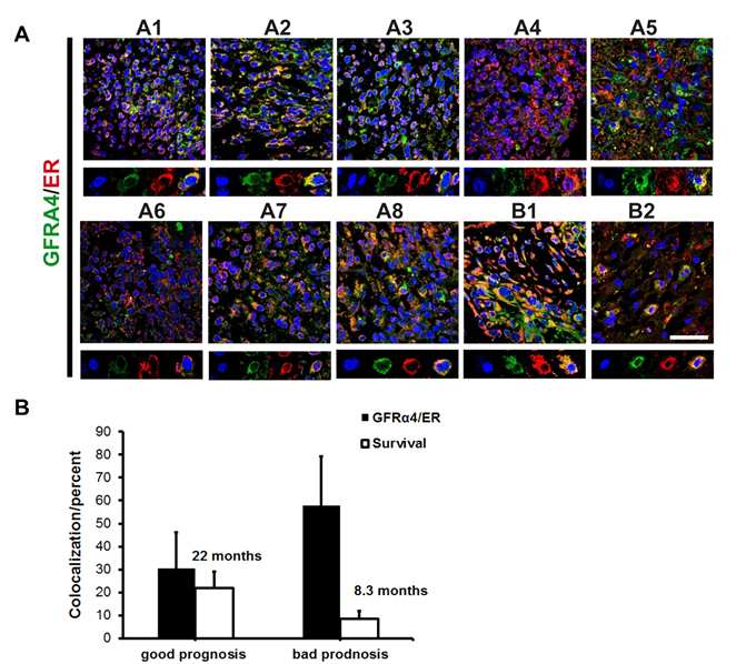 (그림 18. 예후가 다른 뇌종양환자에서 GFRa4와 ER 이중 염색 결과)