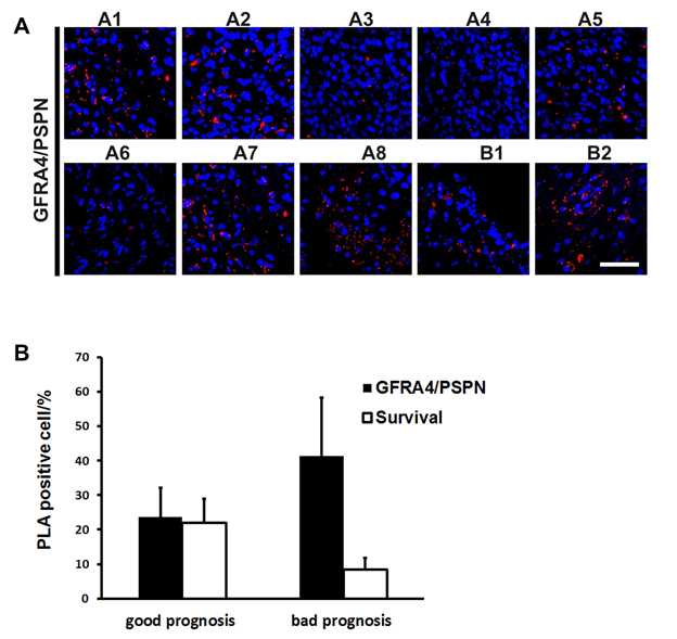(그림 19. 예후가 다른 뇌종양환자에서 GFRa4와 PSPN의 PLA assay 결과)