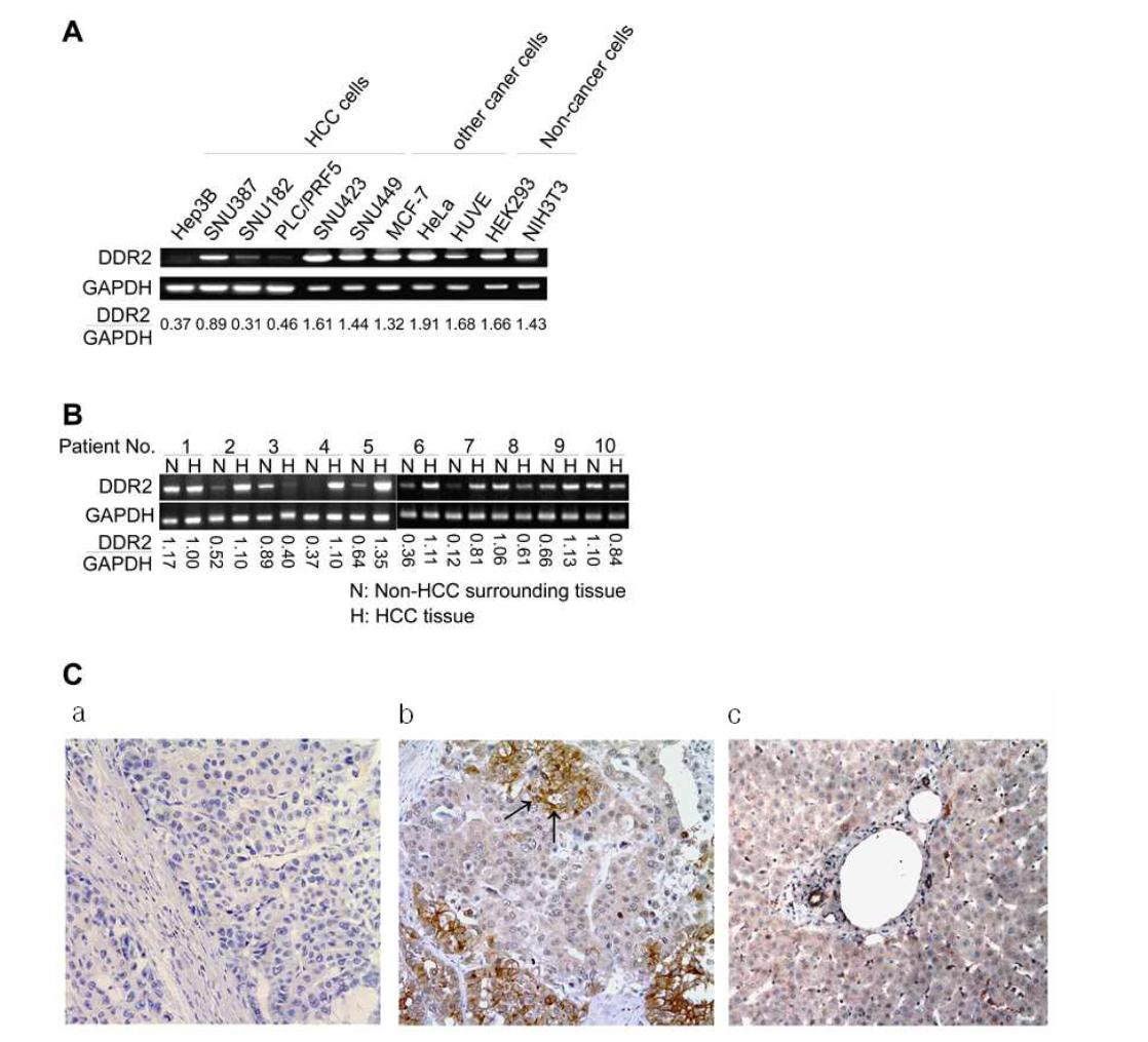 Human HCC in cell lines and patient tissues show DDR2 expression. (A) All of the examined human HCC cell lines expressed DDR2 mRNA, whereby SNU387, SNU423, and SNU449 cells expressed relatively larger amounts of DDR2 mRNA. The entire control group also expressed DDR2 mRNA. (B) All HCC tissues isolated from the five patients with HCC demonstrated DDR2 mRNA expression. While DDR2 expression was more prominent in the HCC tumor compared to the surrounding tissue in three patients, one patient (patient No. 3) showed a reversed pattern of expression. (C) Immunohistochemical staining with anti-DDR2 antibody (b) or without anti-DDR2 antibody (a) in an HCC specimen (trabecular and pseudoglandular type, Edmondson and Steiner’s histologic grade 3, underlying cirrhosis) from a patient showing patchy cytoplasmic or membranous positivity for DDR2. Black arrows indicate the presence of DDR2 at the membrane and in the cytoplasm ; (c) immunohistochemical staining with anti-DDR2 antibody in an normal liver specimen (normal control) showing no stain of hepatocyte and positive stain of bile duct epithelium.