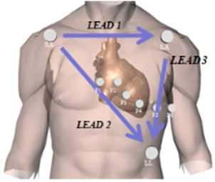 심장의 전기적 활동을 기록하기 위한 표준 심전도(ECG) 전극의 위치