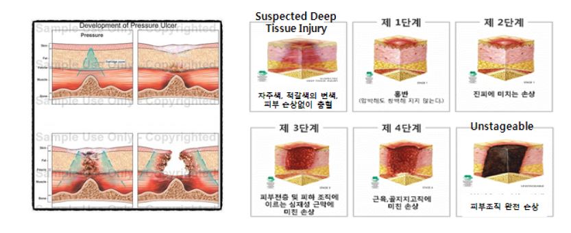 욕창의 진행과정과 단계별 사정